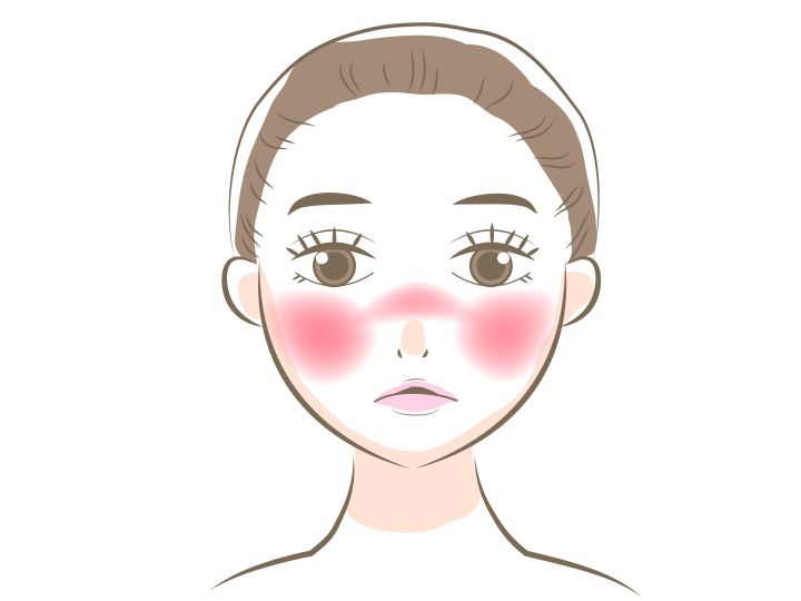 ポテンツァ 赤ら顔